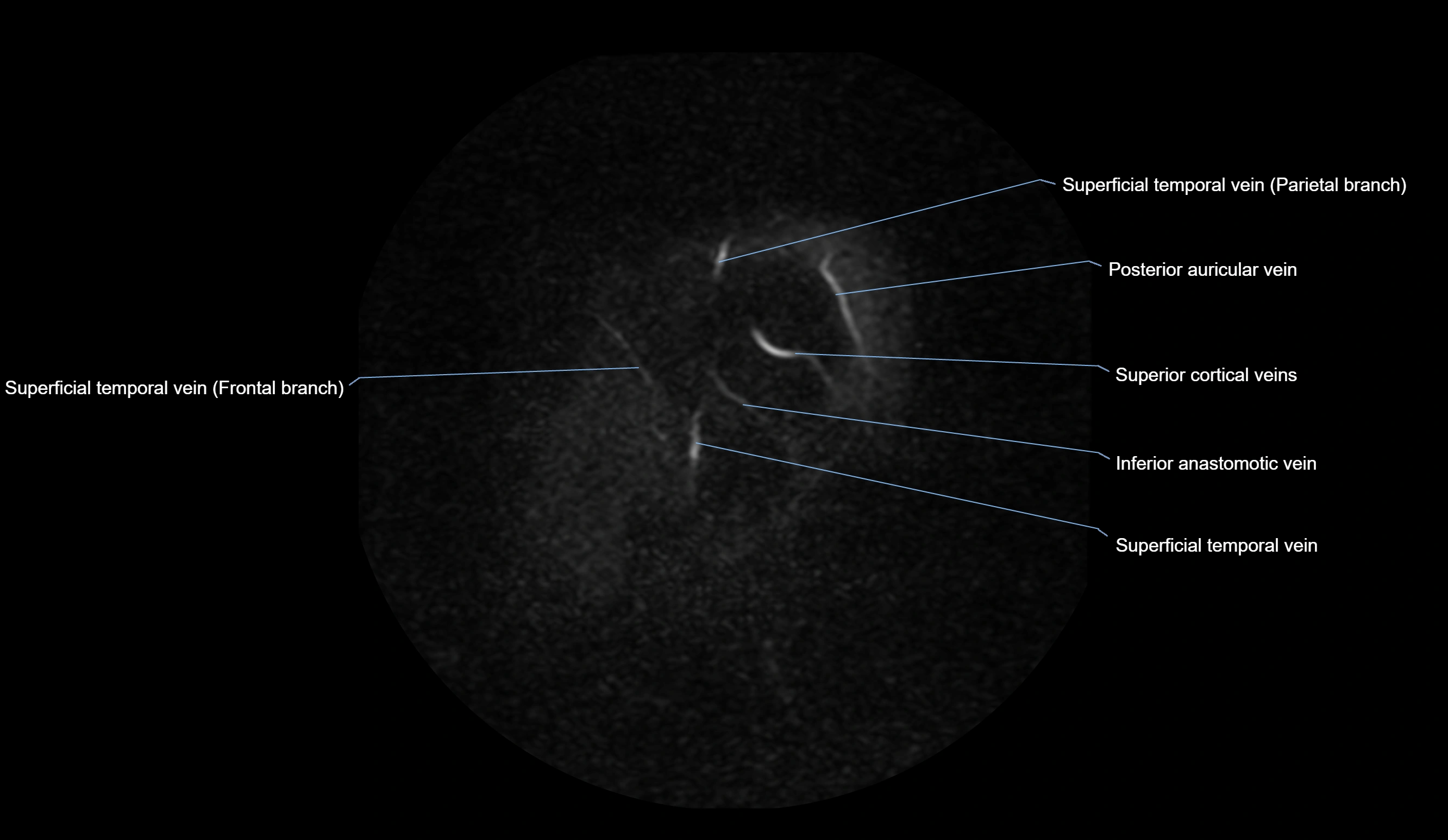 MRV brain sagittal anatomy 3T MRI labelledimages -00009.webp